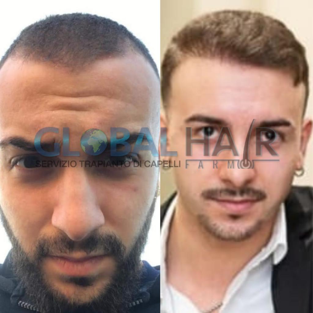 Umberto Prima & Dopo (metodo T.A.I.)